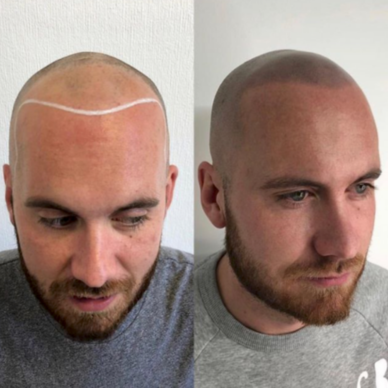 tifón Estimar peligroso Calvicie masculina: Soluciones y tratamientos para alopecia androgénica
